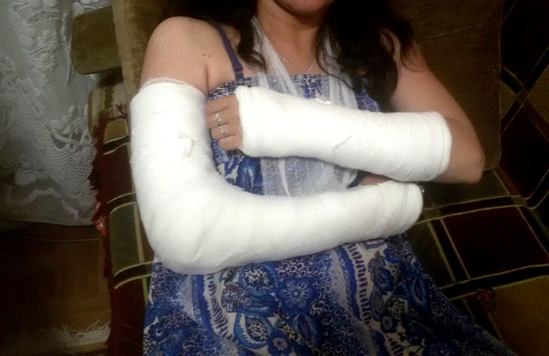Молодая девушка сломала обе руки, выходя из маршрутки в Житомире. ФОТО