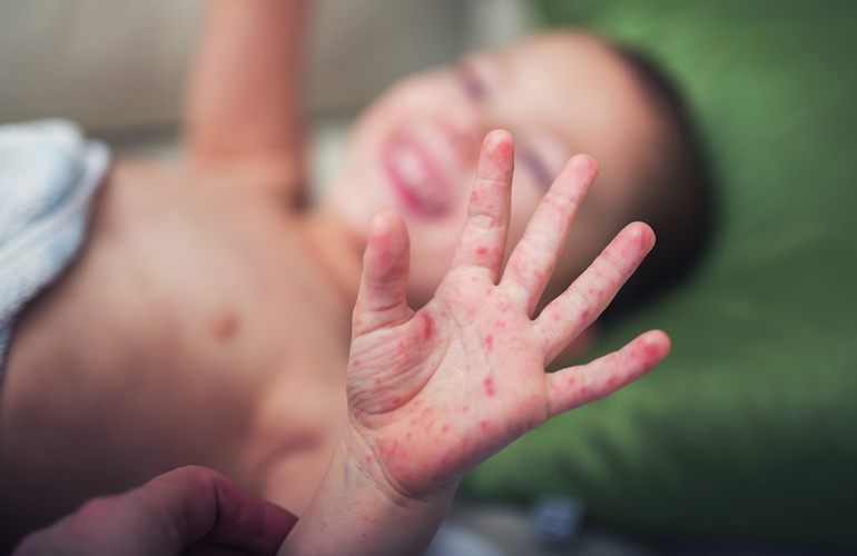 На Житомирщине корью заболели 18 детей, родители которых отказались от прививки