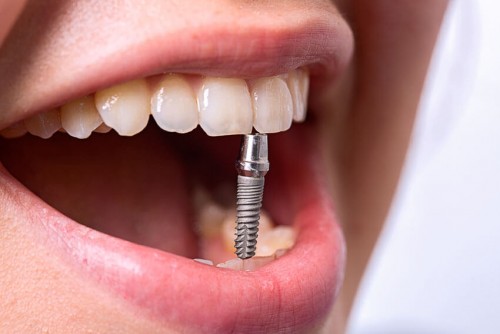 Что собой представляет имплантация зубов?