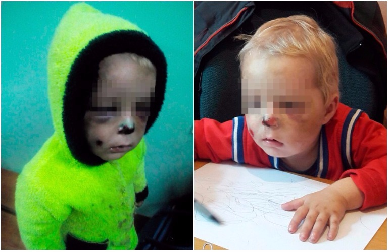 На Житомирщине мать жестоко избила 2-летнего сына, сломав ему нос