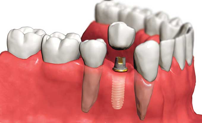 Где лучше всего провести протезирование зубов?
