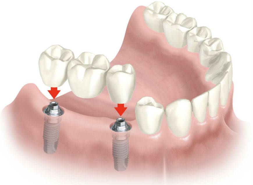 Имплантация зубов – верните себе потрясающую улыбку!