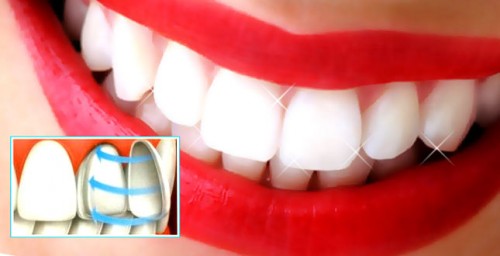 Исправление кривых зубов: когда достаточно установить виниры